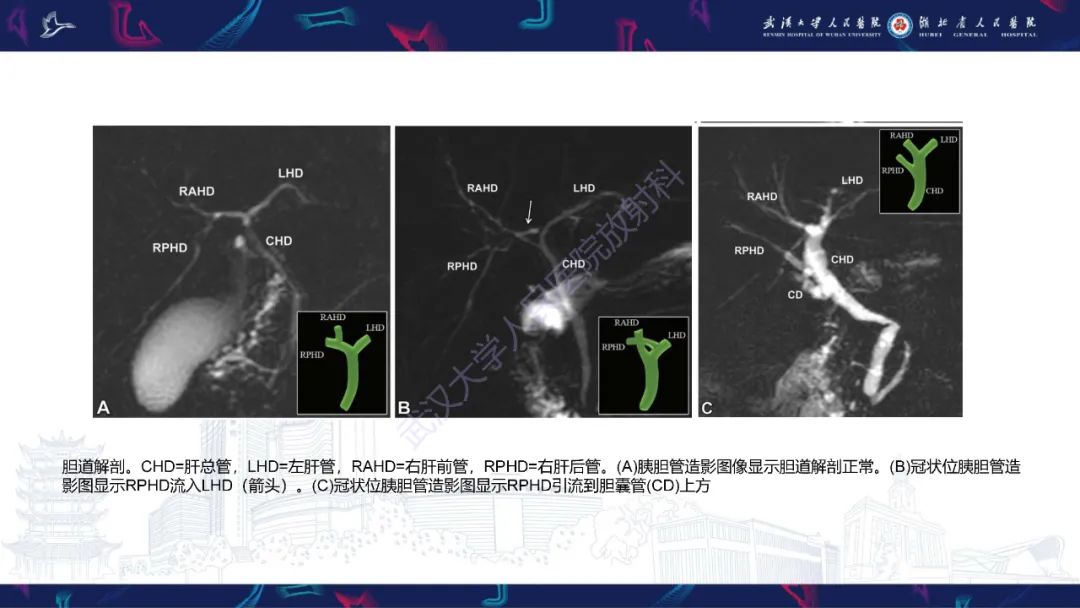 影像PPT - 【PPT】二步肝切除术CT评估-20