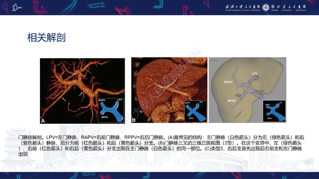 影像PPT - 【PPT】二步肝切除术CT评估-18