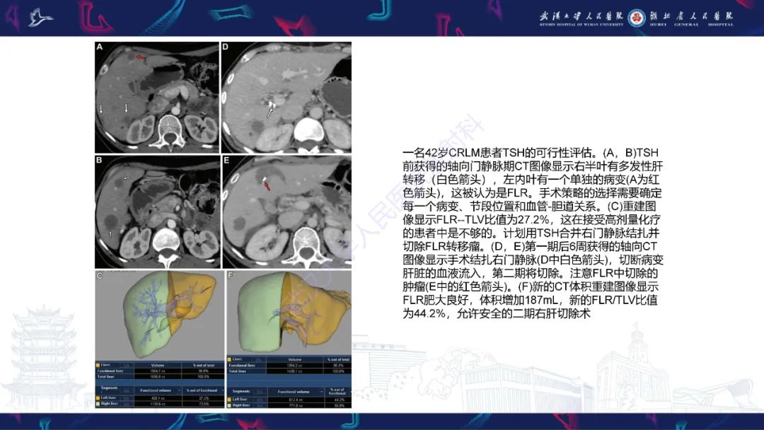 影像PPT - 【PPT】二步肝切除术CT评估-26