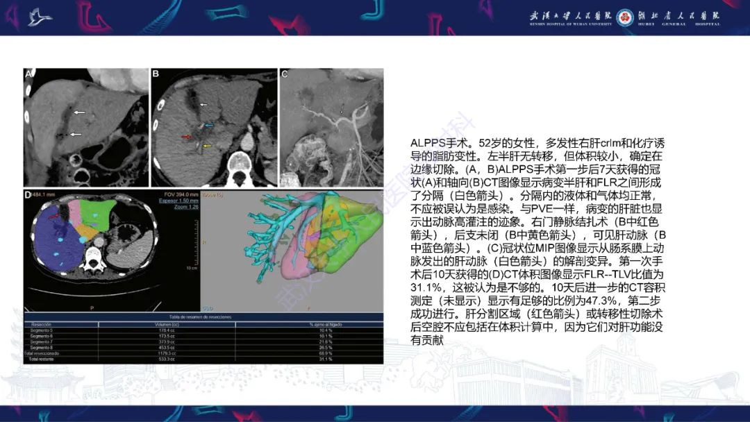 影像PPT - 【PPT】二步肝切除术CT评估-29