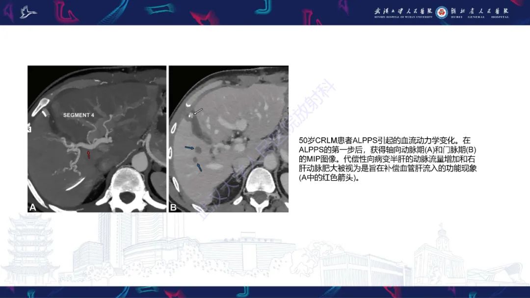 影像PPT - 【PPT】二步肝切除术CT评估-30