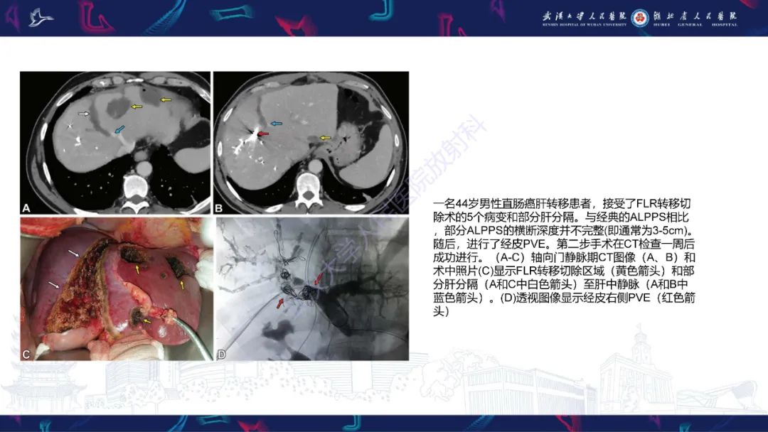 影像PPT - 【PPT】二步肝切除术CT评估-31