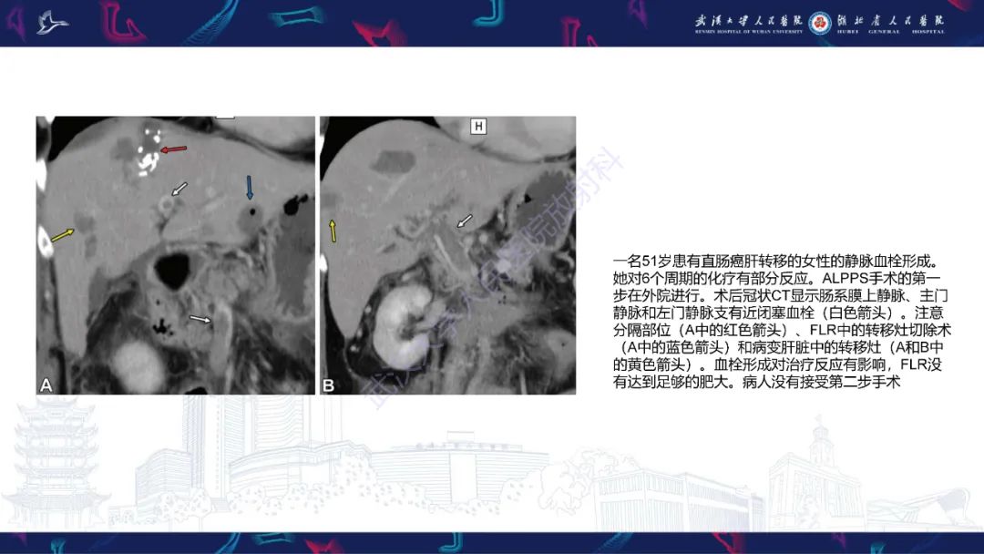 影像PPT - 【PPT】二步肝切除术CT评估-35