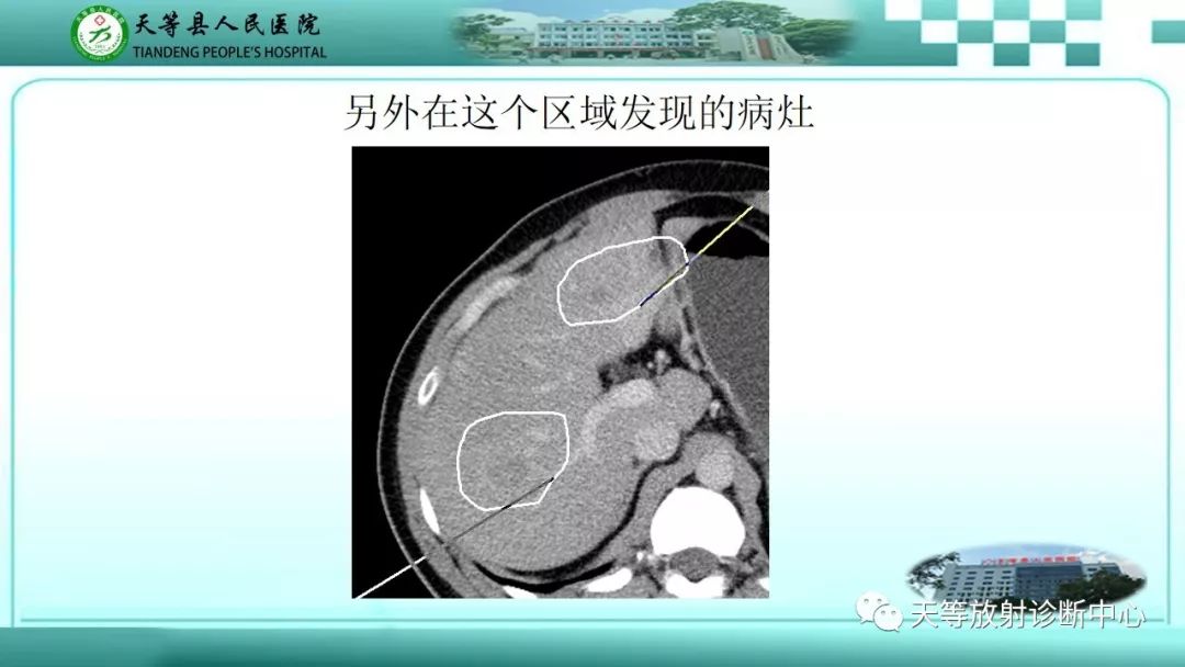 影像PPT - 【PPT】胰腺内分泌肿瘤-4