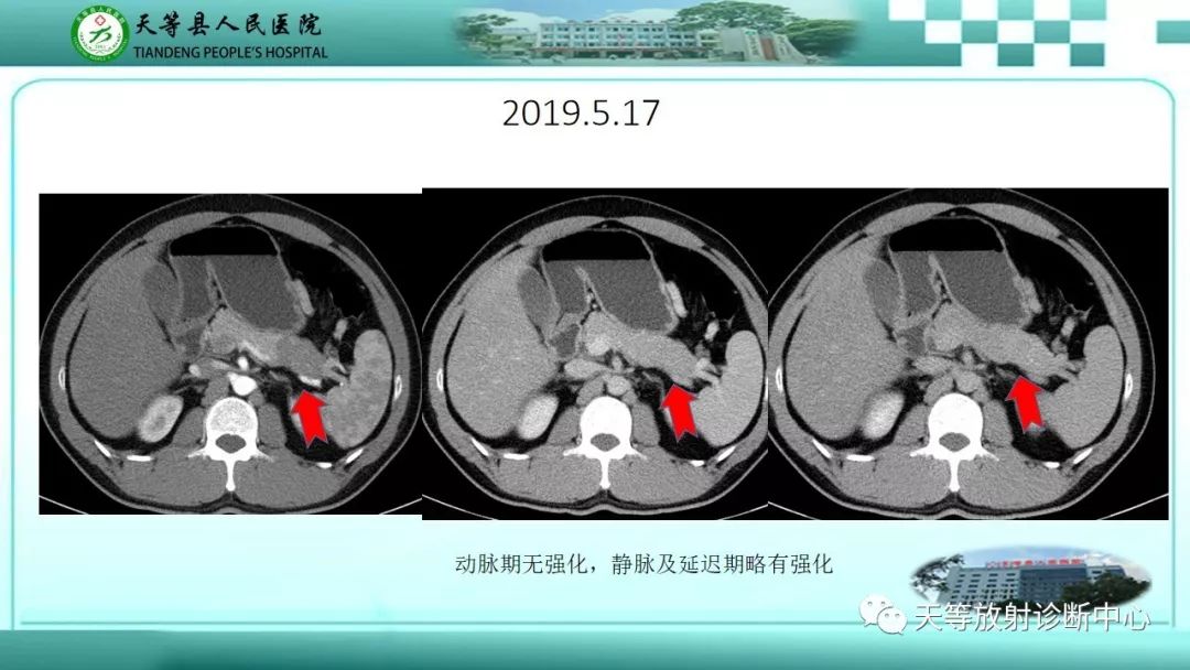 影像PPT - 【PPT】胰腺内分泌肿瘤-3