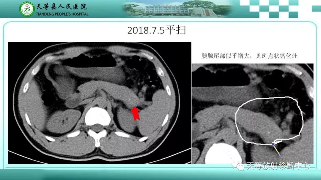 影像PPT - 【PPT】胰腺内分泌肿瘤-2