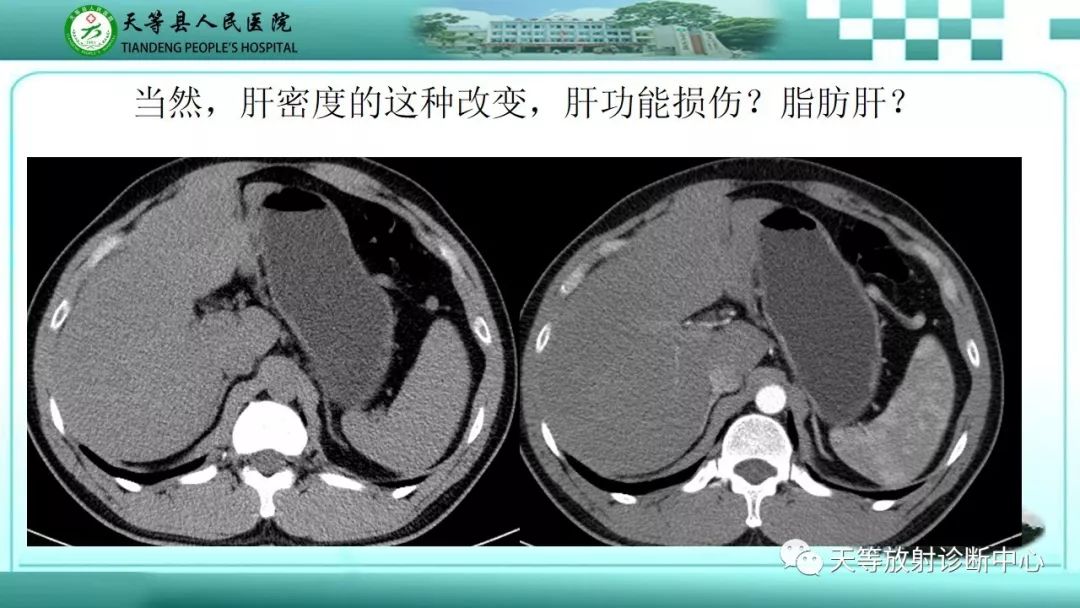影像PPT - 【PPT】胰腺内分泌肿瘤-5