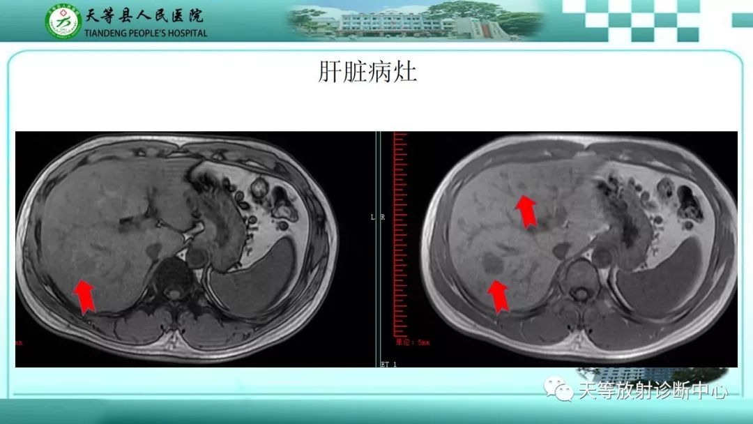 影像PPT - 【PPT】胰腺内分泌肿瘤-8
