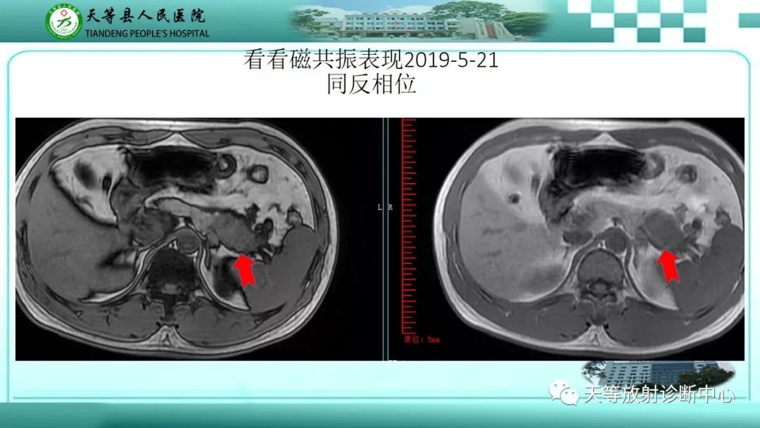 影像PPT - 【PPT】胰腺内分泌肿瘤-7