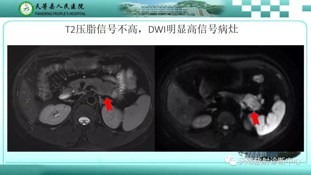 影像PPT - 【PPT】胰腺内分泌肿瘤-9