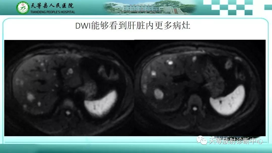 影像PPT - 【PPT】胰腺内分泌肿瘤-10
