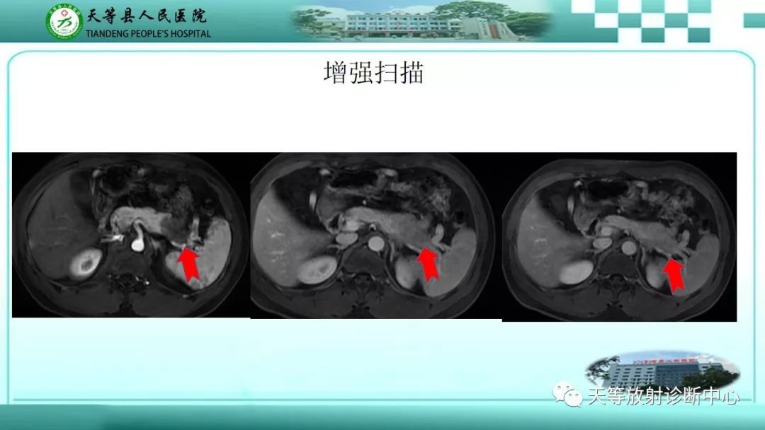 影像PPT - 【PPT】胰腺内分泌肿瘤-11