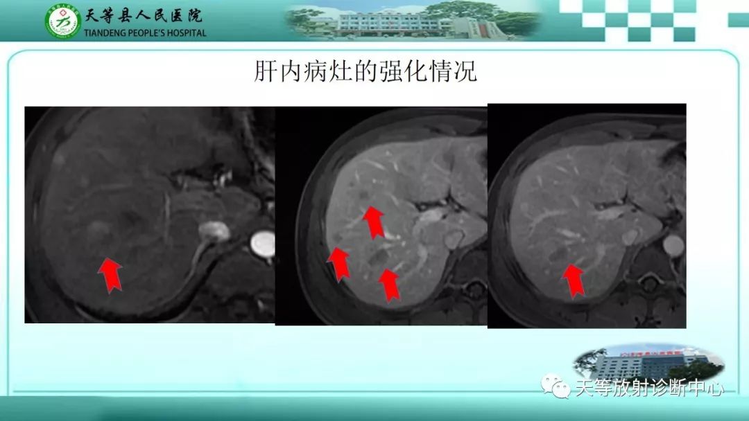 影像PPT - 【PPT】胰腺内分泌肿瘤-12