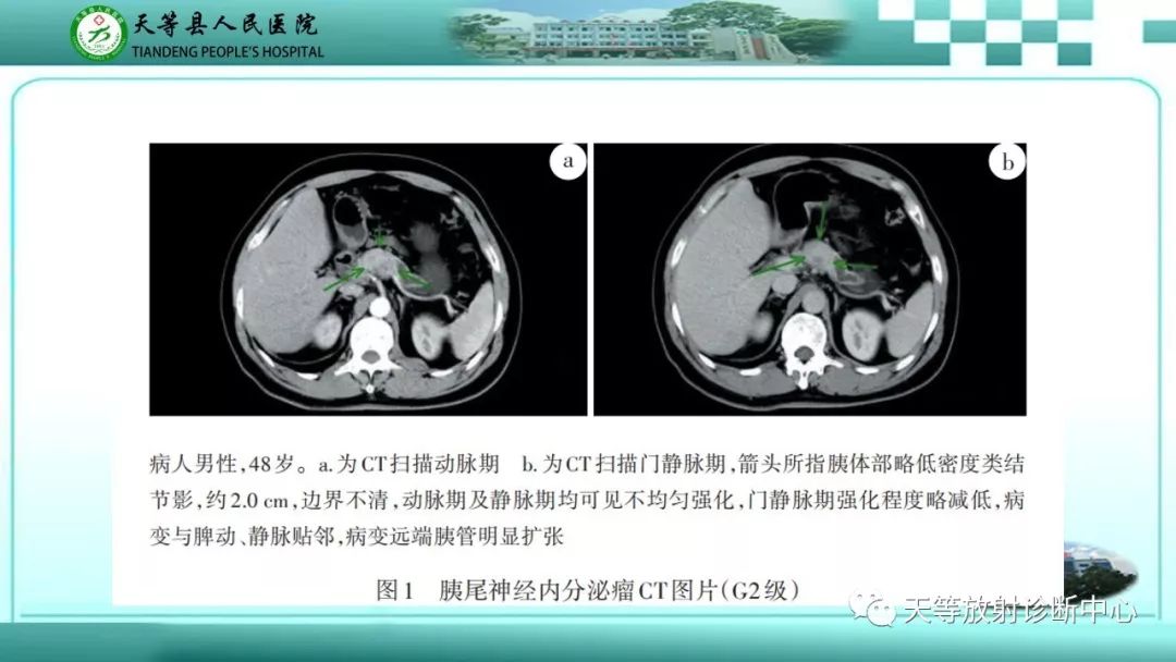 影像PPT - 【PPT】胰腺内分泌肿瘤-21