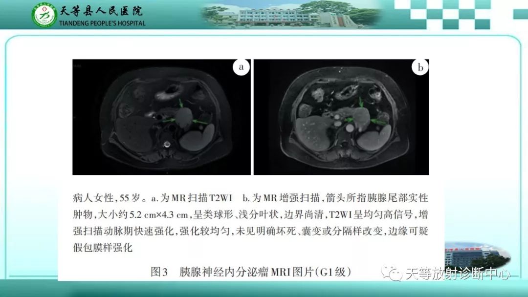 影像PPT - 【PPT】胰腺内分泌肿瘤-22
