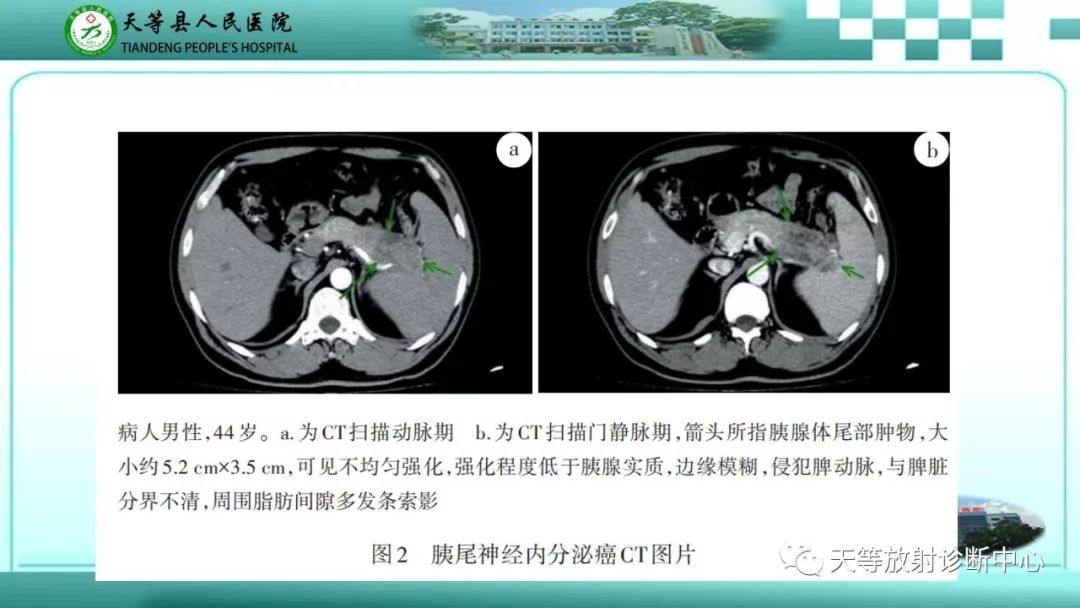 影像PPT - 【PPT】胰腺内分泌肿瘤-24