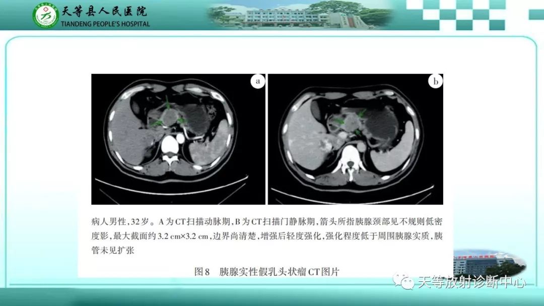 影像PPT - 【PPT】胰腺内分泌肿瘤-31