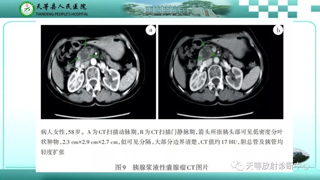 影像PPT - 【PPT】胰腺内分泌肿瘤-34