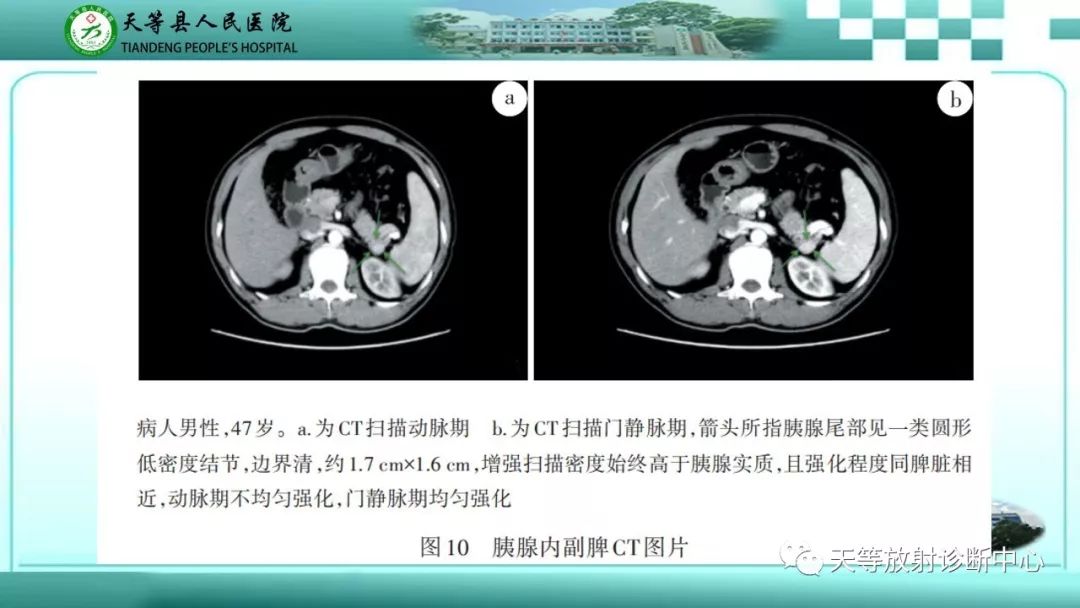影像PPT - 【PPT】胰腺内分泌肿瘤-37