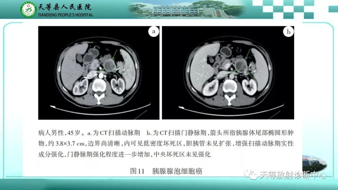 影像PPT - 【PPT】胰腺内分泌肿瘤-39