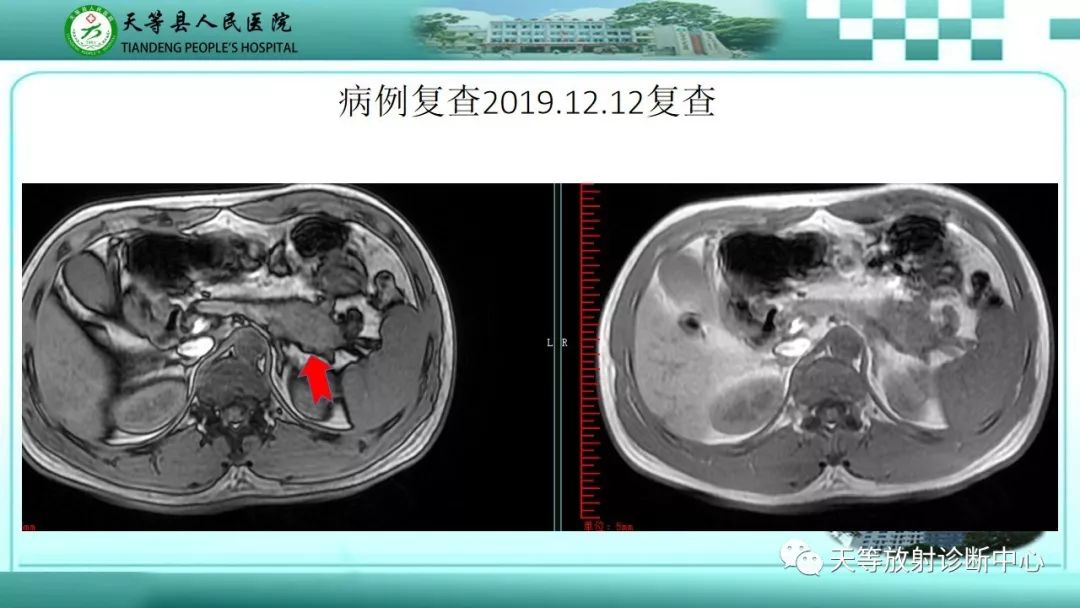 影像PPT - 【PPT】胰腺内分泌肿瘤-40