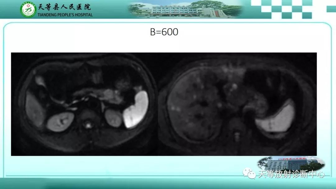 影像PPT - 【PPT】胰腺内分泌肿瘤-41