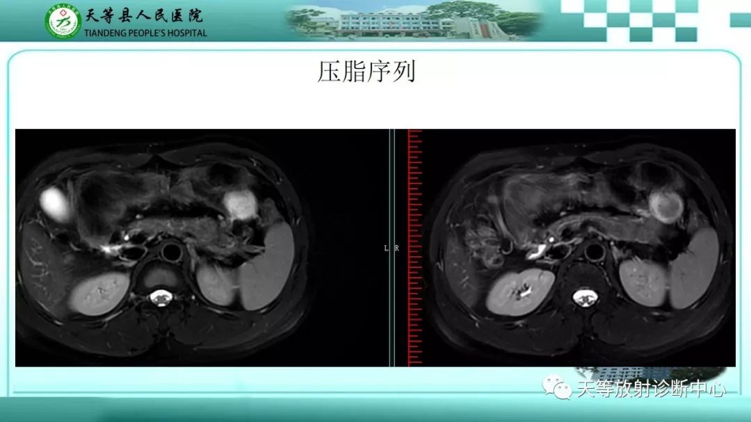 影像PPT - 【PPT】胰腺内分泌肿瘤-42