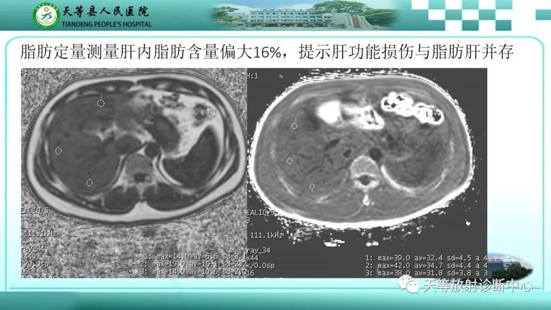 影像PPT - 【PPT】胰腺内分泌肿瘤-44