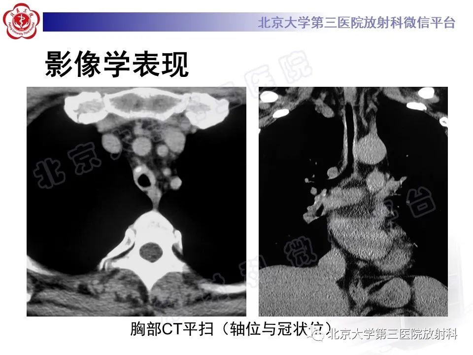 影像PPT - 【PPT】复发性多软骨炎-3
