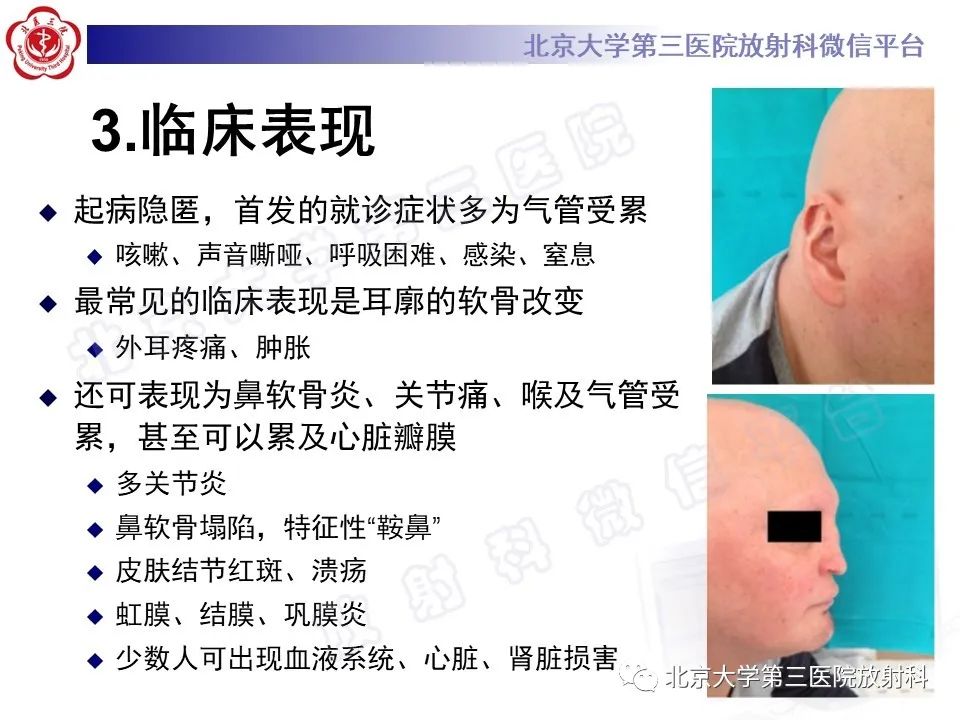 影像PPT - 【PPT】复发性多软骨炎-9
