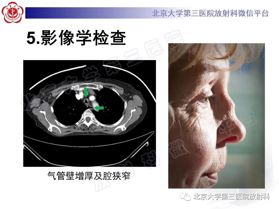 影像PPT - 【PPT】复发性多软骨炎-13