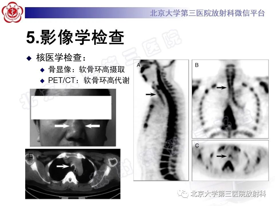 影像PPT - 【PPT】复发性多软骨炎-14