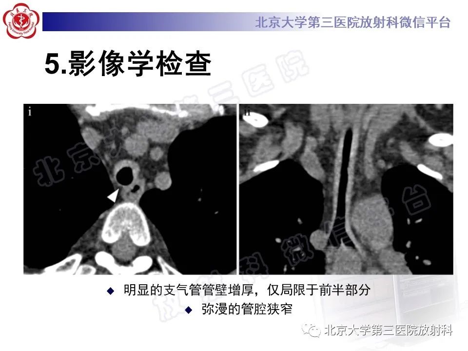 影像PPT - 【PPT】复发性多软骨炎-12