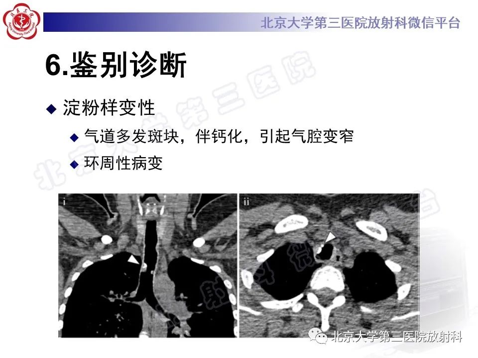 影像PPT - 【PPT】复发性多软骨炎-16