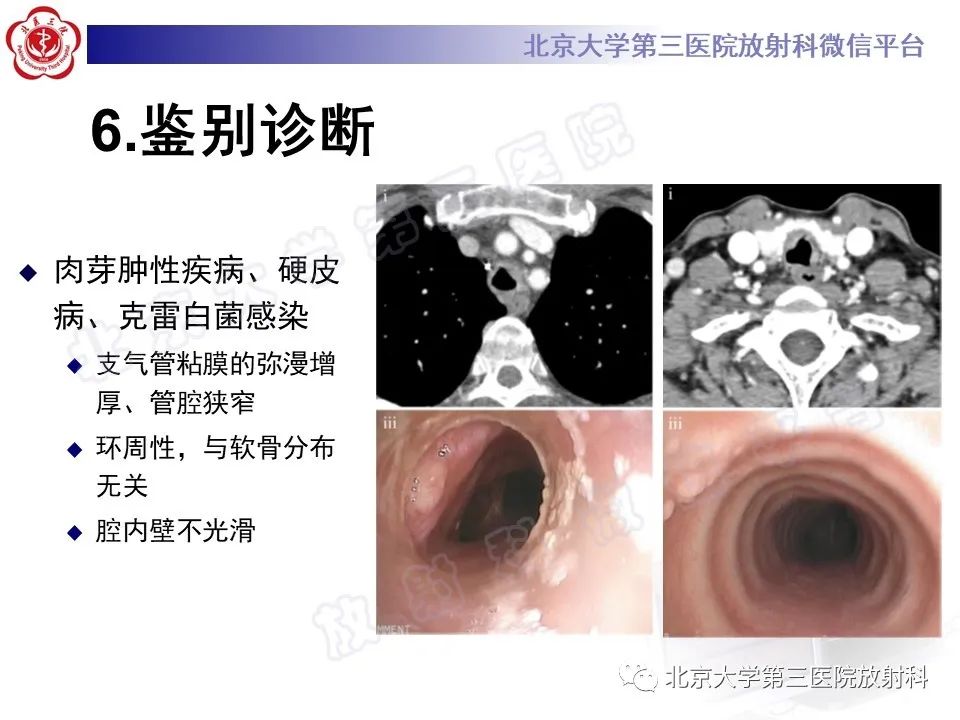 影像PPT - 【PPT】复发性多软骨炎-17