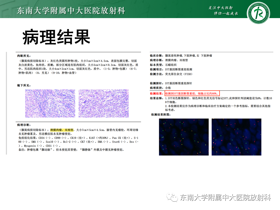 影像PPT - 【PPT】膝关节滑膜肉瘤-3 影像PPT - 【PPT】膝关节滑膜肉瘤-3