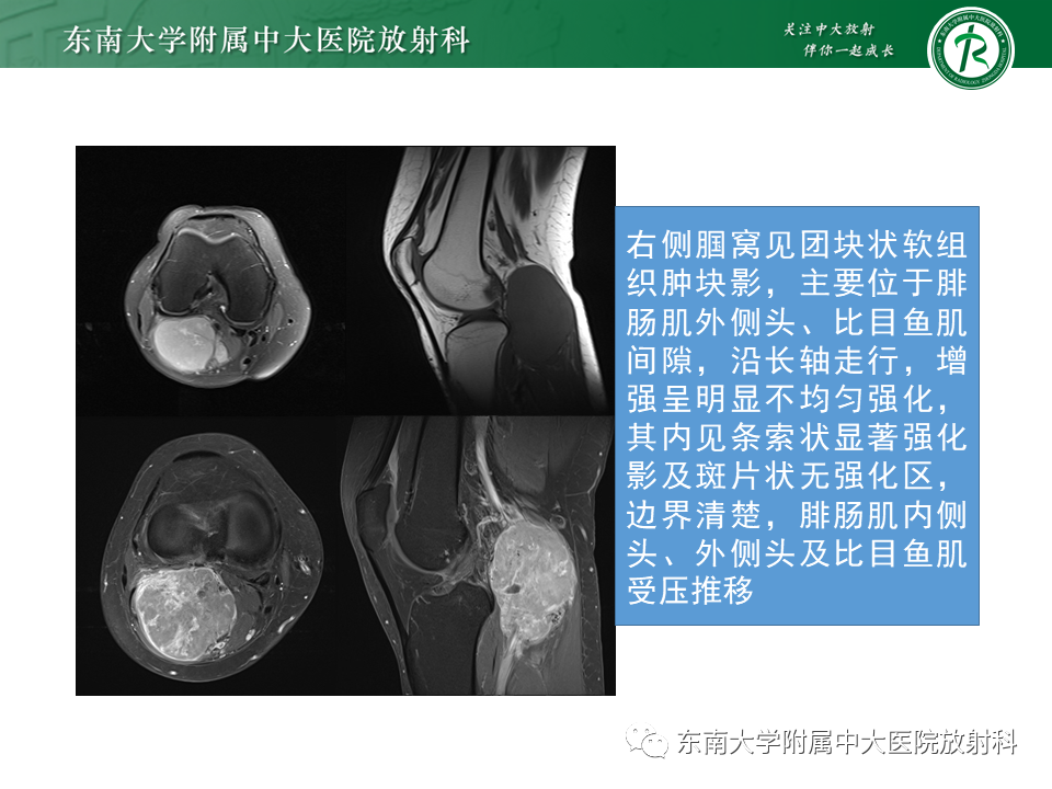 影像PPT - 【PPT】膝关节滑膜肉瘤-2 影像PPT - 【PPT】膝关节滑膜肉瘤-2