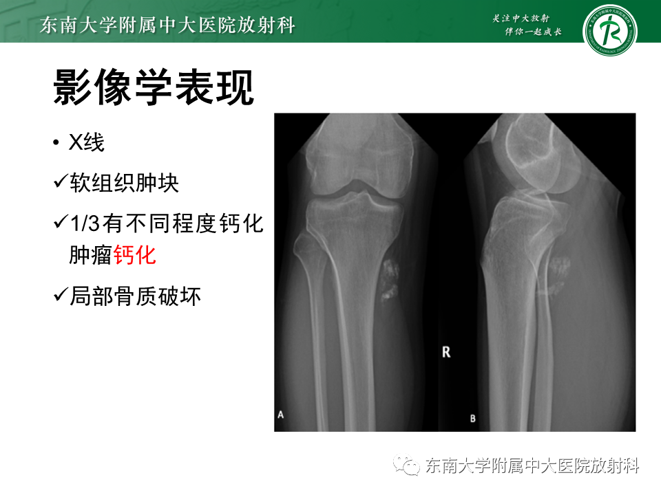 影像PPT - 【PPT】膝关节滑膜肉瘤-8 影像PPT - 【PPT】膝关节滑膜肉瘤-8