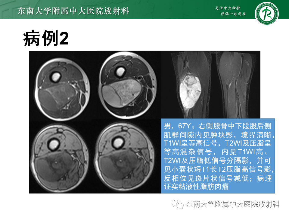 影像PPT - 【PPT】膝关节滑膜肉瘤-12 影像PPT - 【PPT】膝关节滑膜肉瘤-12