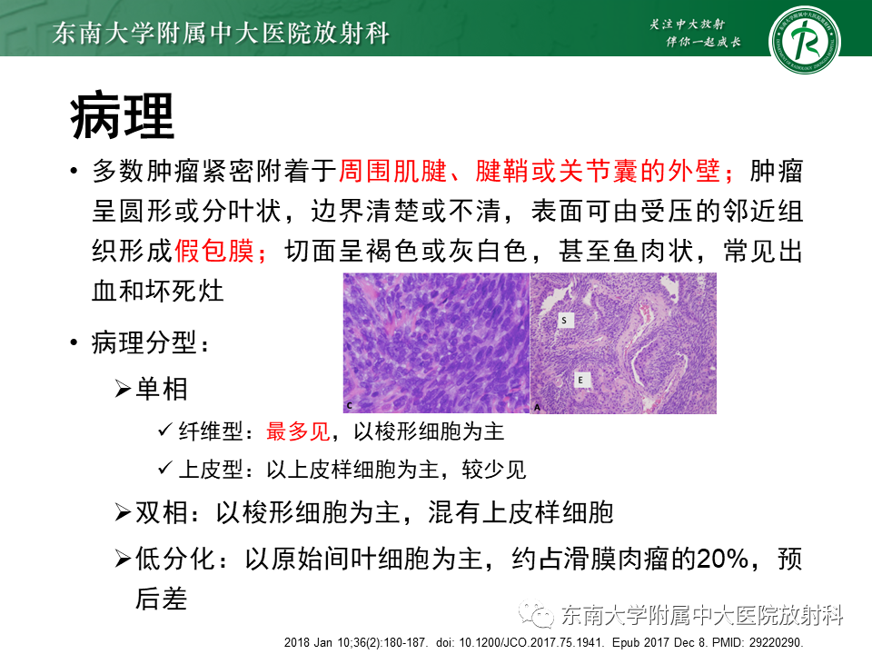影像PPT - 【PPT】膝关节滑膜肉瘤-6 影像PPT - 【PPT】膝关节滑膜肉瘤-6