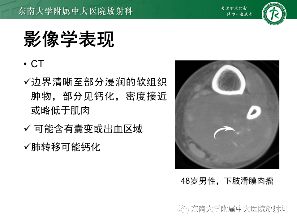 影像PPT - 【PPT】膝关节滑膜肉瘤-9 影像PPT - 【PPT】膝关节滑膜肉瘤-9