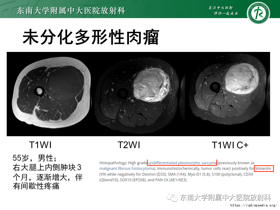 影像PPT - 【PPT】膝关节滑膜肉瘤-17 影像PPT - 【PPT】膝关节滑膜肉瘤-17