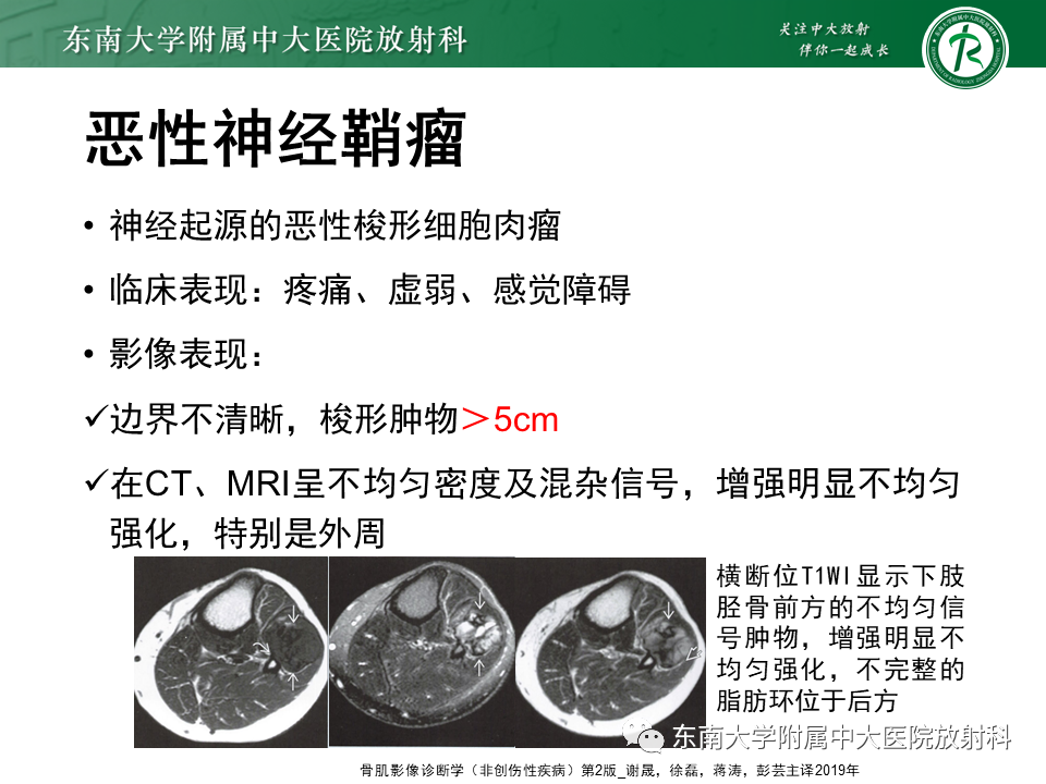 影像PPT - 【PPT】膝关节滑膜肉瘤-28 影像PPT - 【PPT】膝关节滑膜肉瘤-28