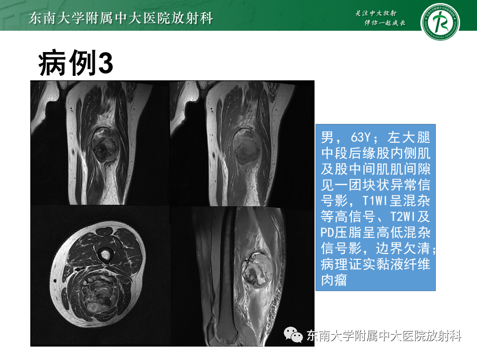 影像PPT - 【PPT】膝关节滑膜肉瘤-18 影像PPT - 【PPT】膝关节滑膜肉瘤-18