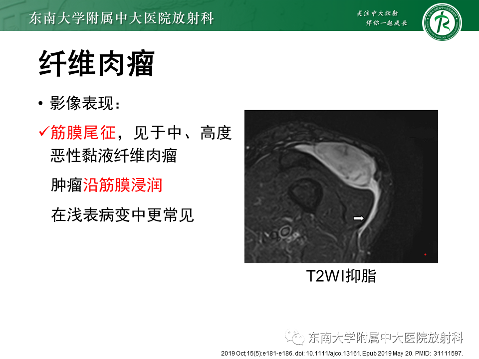 影像PPT - 【PPT】膝关节滑膜肉瘤-21 影像PPT - 【PPT】膝关节滑膜肉瘤-21