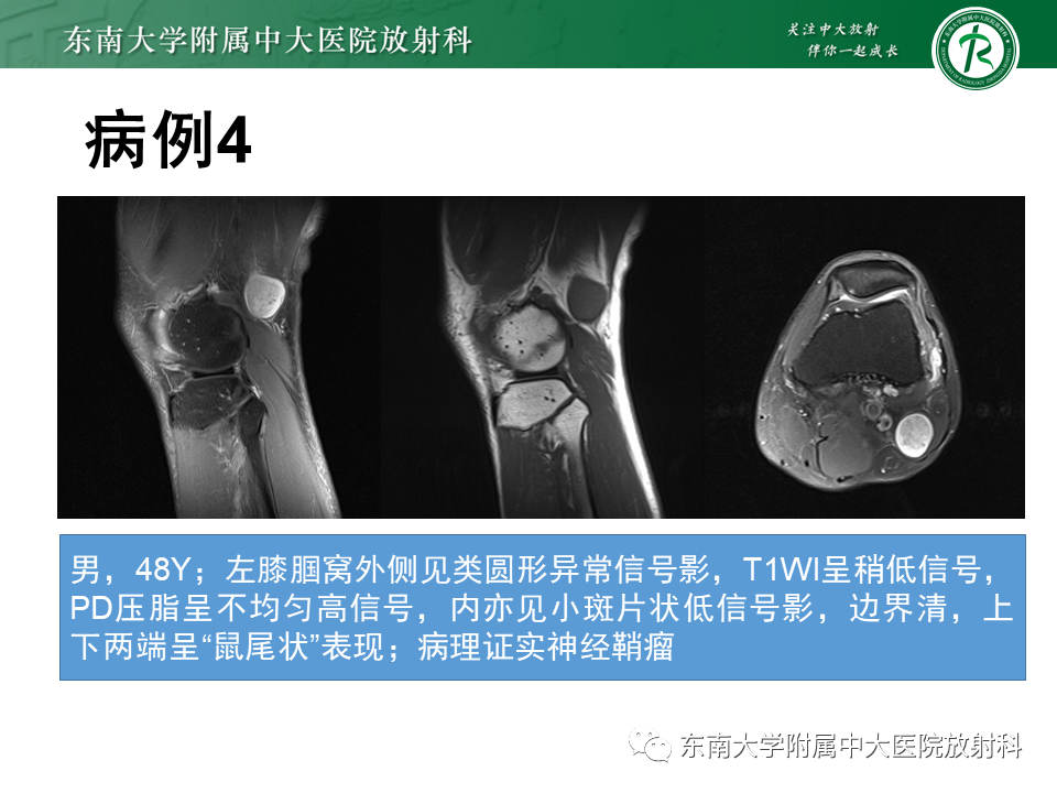 影像PPT - 【PPT】膝关节滑膜肉瘤-25 影像PPT - 【PPT】膝关节滑膜肉瘤-25