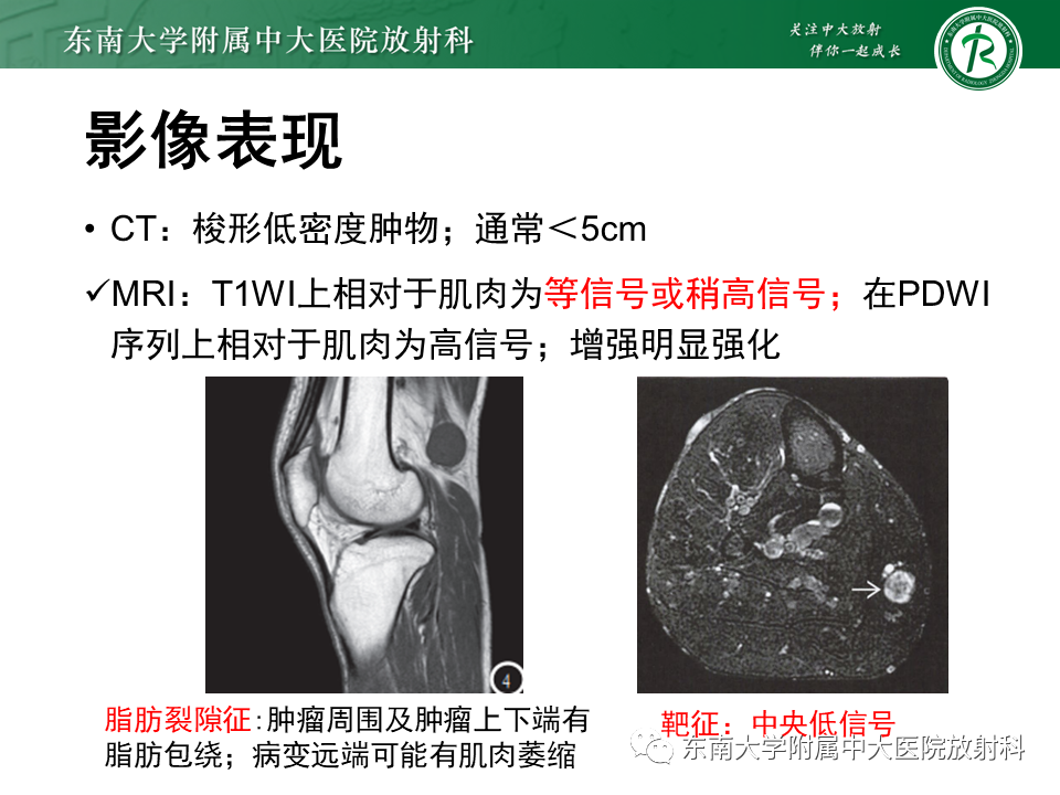 影像PPT - 【PPT】膝关节滑膜肉瘤-27 影像PPT - 【PPT】膝关节滑膜肉瘤-27