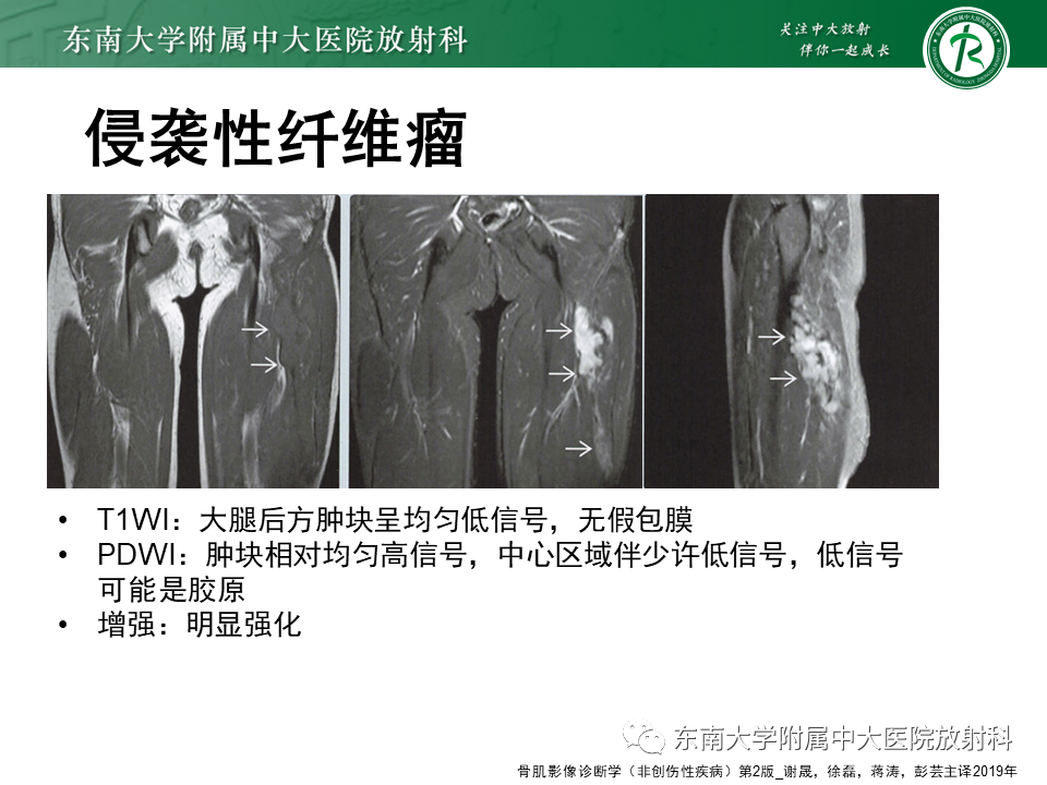 影像PPT - 【PPT】膝关节滑膜肉瘤-24 影像PPT - 【PPT】膝关节滑膜肉瘤-24