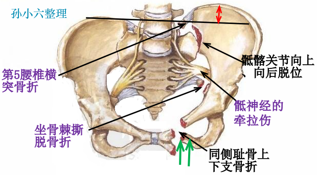 影像PPT - 马刺征、海鸥征、新月形、翻书样、风卷样骨折,这些特殊骨折征象你都见过吗?-8 影像PPT - 马刺征、海鸥征、新月形、翻书样、风卷样骨折,这些特殊骨折征象你都见过吗?-8