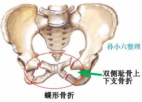 影像PPT - 马刺征、海鸥征、新月形、翻书样、风卷样骨折,这些特殊骨折征象你都见过吗?-6 影像PPT - 马刺征、海鸥征、新月形、翻书样、风卷样骨折,这些特殊骨折征象你都见过吗?-6